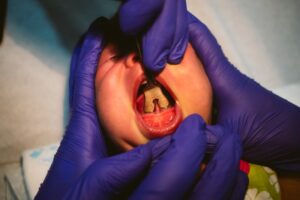 Baby receiving frenectomy. 